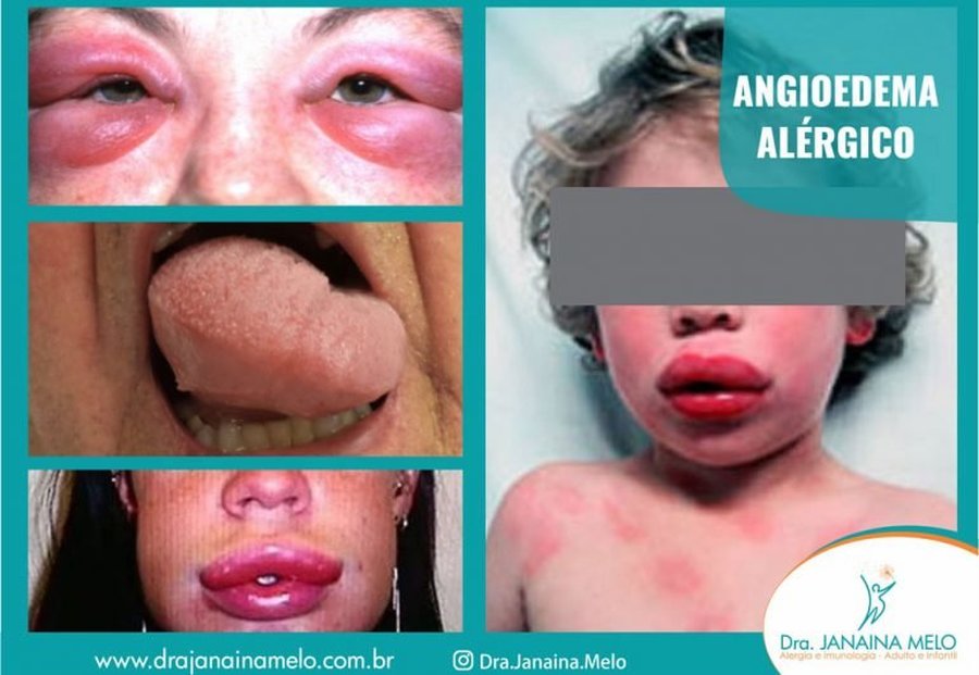 O QUE É ANGIOEDEMA ALÉRGICO?