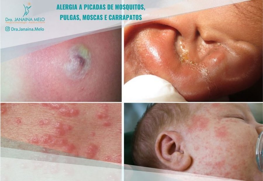 ALERGIA A PICADAS DE MOSQUITOS, PULGAS, MOSCAS E CARRAPATOS