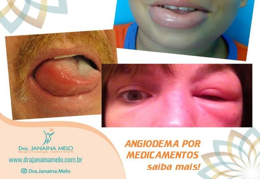 ANGIOEDEMA POR MEDICAMENTOS