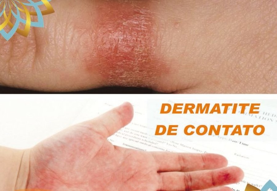 DERMATITE DE CONTATO – COMO IDENTIFICAR E PREVENIR?