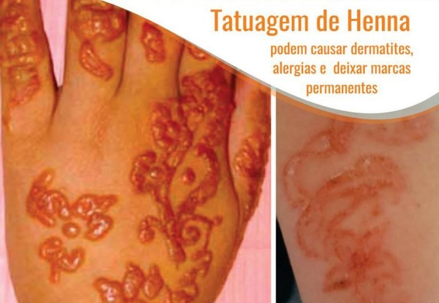 TATUAGENS DE HENNA PODEM CAUSAR ALERGIAS E DERMATITES?