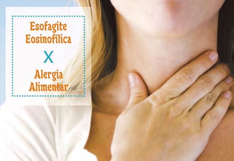 ESOFAGITE EOSINOFÍLICA X ALERGIA ALIMENTAR