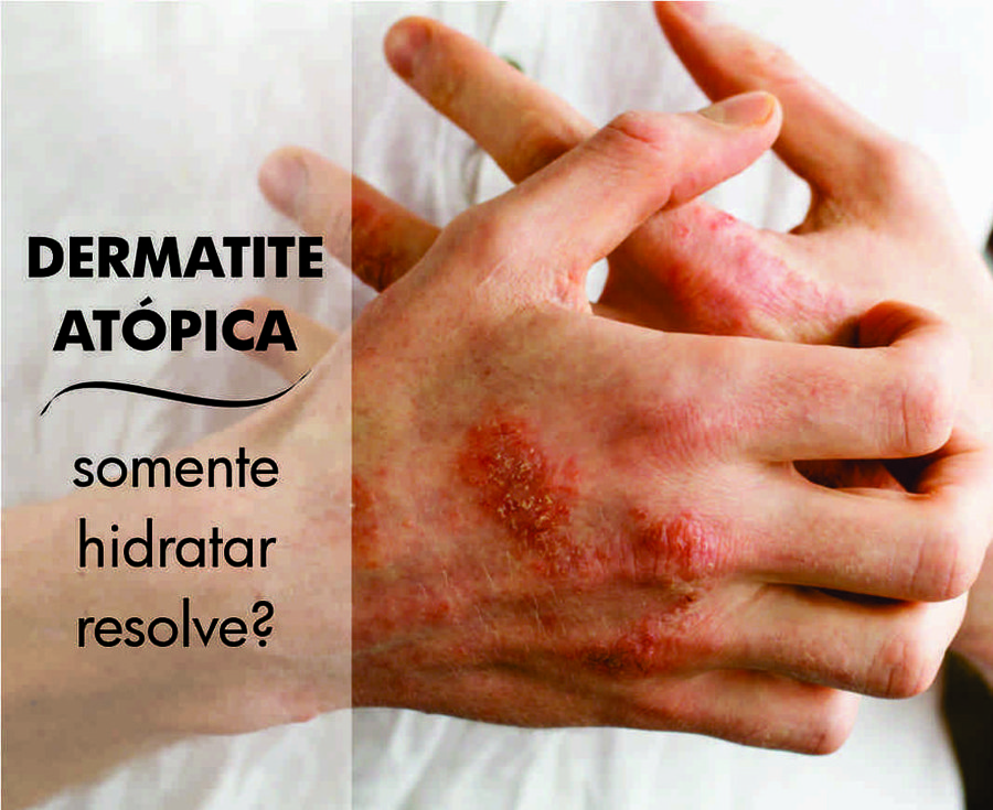 Dermatite Atópica - Só Hidratar Resolve? 