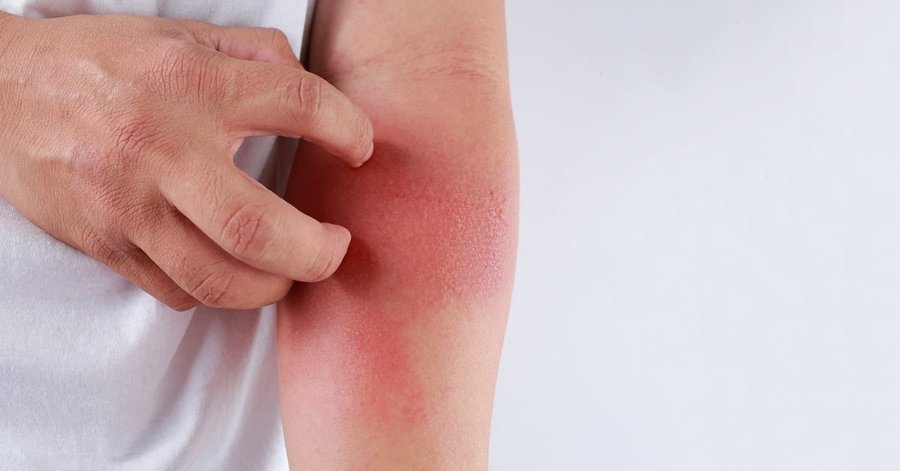 Dermatite de contato por corticoide