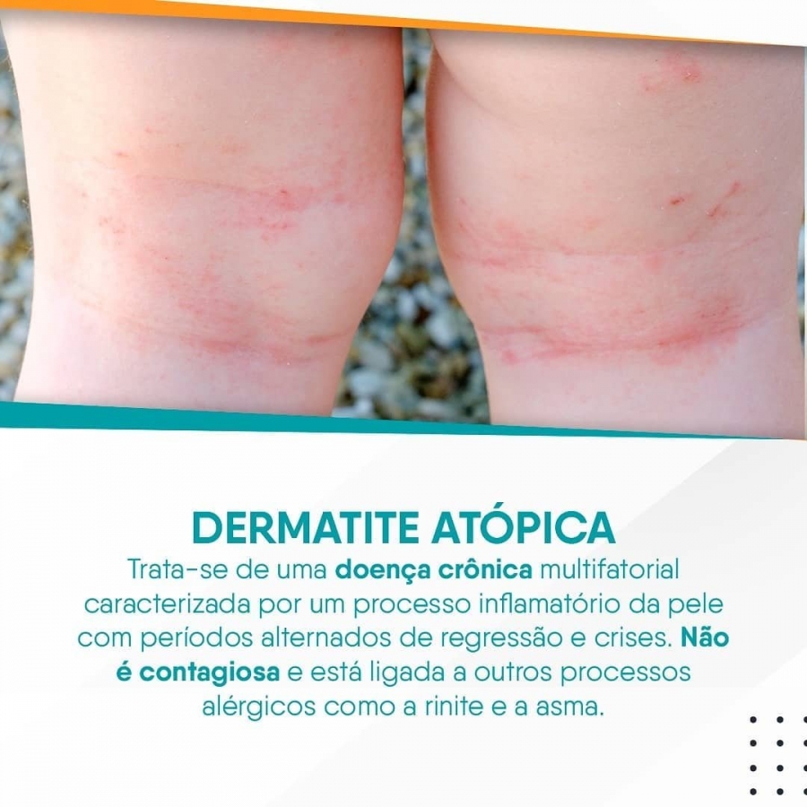 Dermatite Atópica