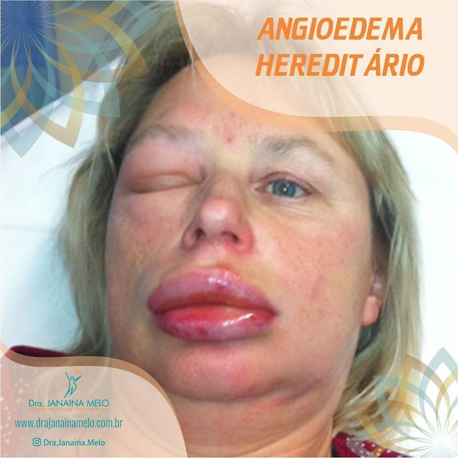 Angioedema Hereditário (AEH)