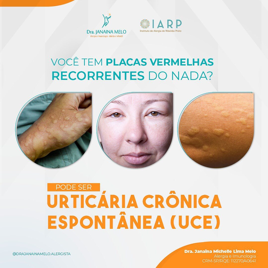 Pode ser UCE (Urticária Crônica Espontânea