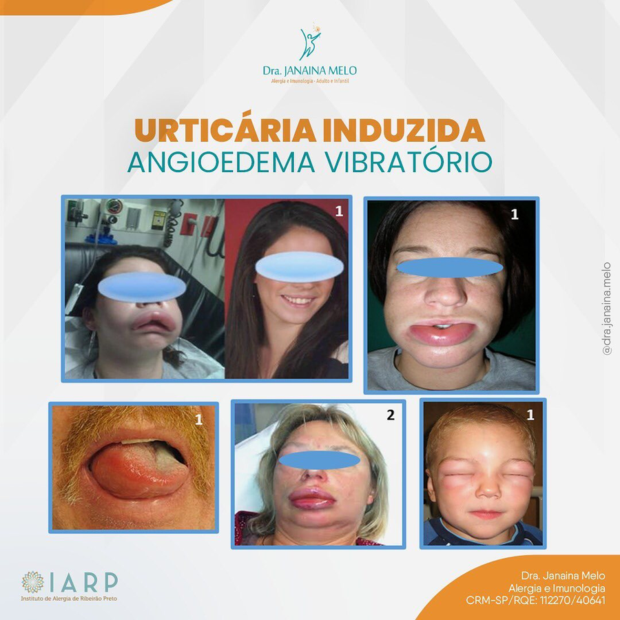 Urticária Induzida Angioedema Vibratório