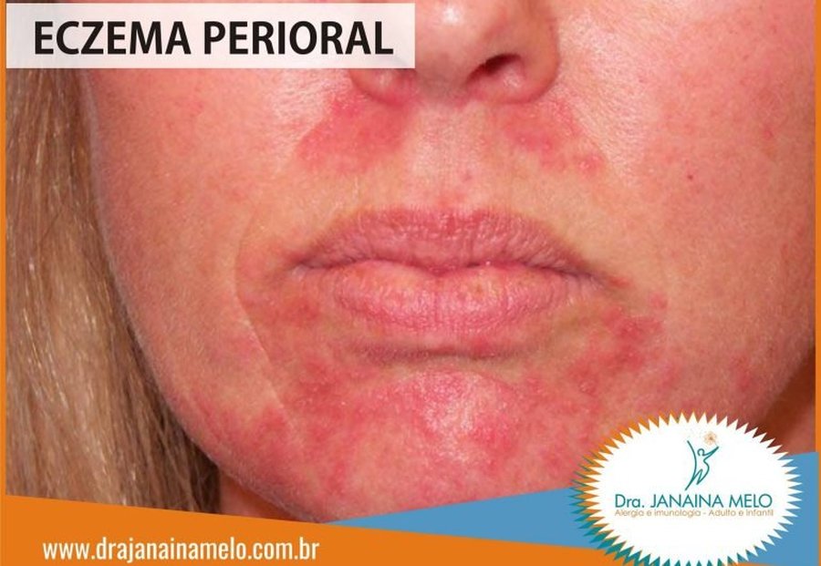 ECZEMA PERIORAL – CAUSADO PELO FRIO? MITO OU VERDADE