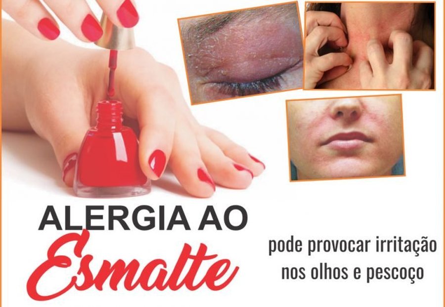 ALERGIA AO ESMALTE DE UNHAS