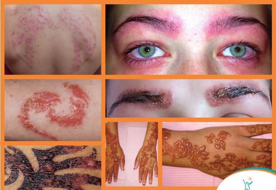 ALERGIA A TATUAGEM FEITA COM HENA