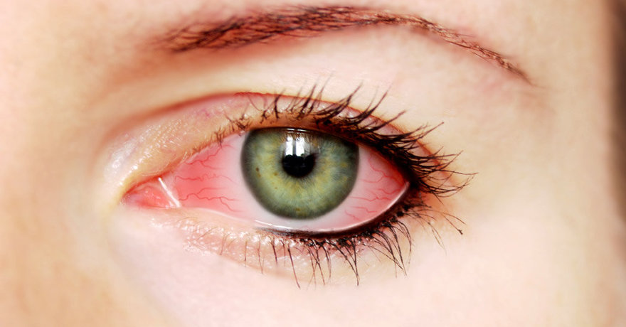ALERGIA OCULAR
